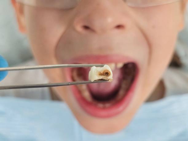 Best Knocked-Out Tooth Emergency  in Decatur, IN